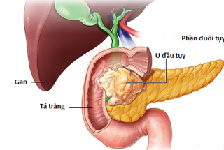 NHỮNG ĐIỀU CẦN BIẾT VỀ UNG THƯ TUYẾN TỤY